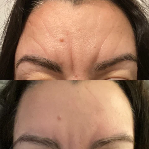 Before and after forehead wrinkle reduction results