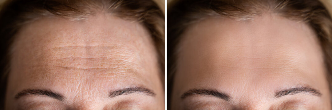 Before and after forehead line reduction