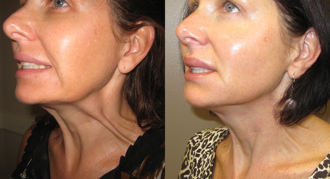 Before and after facial contouring and jawline improvement